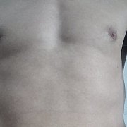 81Md - man, 44 years, Almelo